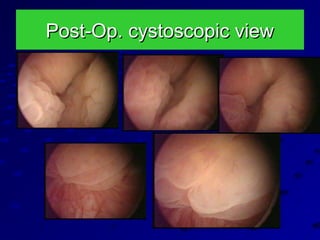 Post-Op. cystoscopic viewPost-Op. cystoscopic view
 