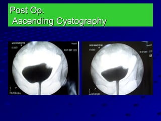 Post Op.Post Op.
Ascending CystographyAscending Cystography
 