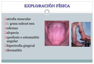 EXPLORACIÓN FÍSICA atrofia muscular ↓  g rasa subcutánea edemas alopecia queilosis o estomatitis angular hipertrofia gingival dermatitis 