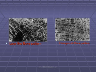  Lace like Bone pattern

www.indiandentalacademy.com

Honeycomb Bone pattern

 