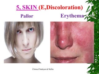 Pallor Types Adult physical assessment | PPT