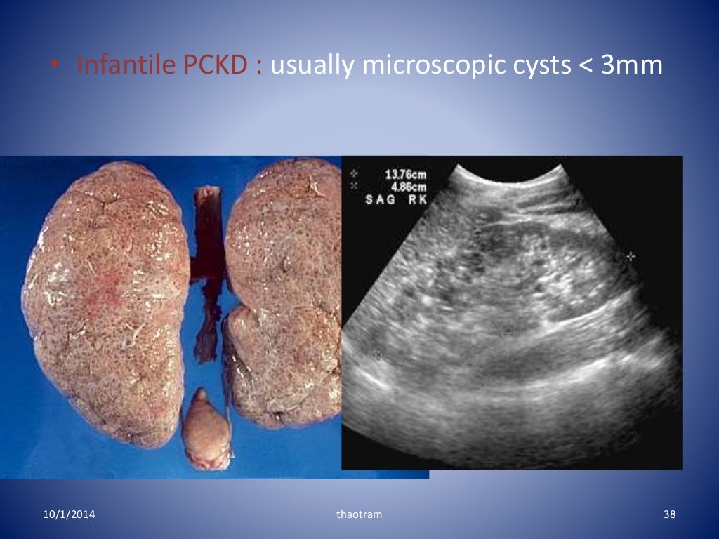 Adult polycystic kidney disease