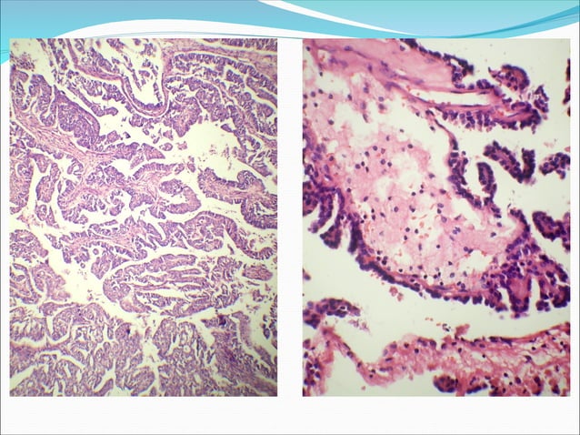ADULT RENAL TUMORS OR RCC (PATHOLOGY PRESENTATION) | PPT | Endocrine ...