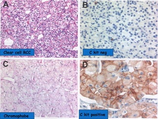 ADULT RENAL TUMORS OR RCC (PATHOLOGY PRESENTATION) | PPT