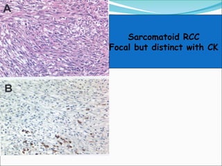 ADULT RENAL TUMORS OR RCC (PATHOLOGY PRESENTATION) | PPT