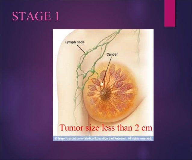 Tumor Size Less Than 2 Cm Stage 1 Tumor Size Less Than 2 Cm Stage 1