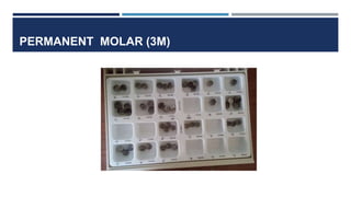 PERMANENT MOLAR (3M)
 