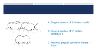A. Gingival contour of 2nd molar- ‘smile’
B. Gingival contour of 1st molar –
‘stretched s’
C.Proximal gingival contour of molars –
‘frown’
 