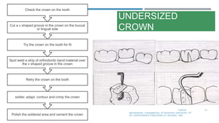 UNDERSIZED
CROWN
7/9/2019 72
MATHEWSON.: FUNDAMENTAL OF PEDIATRIC DENTISTRY. 3RD
ED. QUINTESSENCE PUBLISHING CO. SHICAGO, 1995Polish the soldered area and cement the crown
solder, adapt, contour and crimp the crown
Retry the crown on the tooth
Spot weld a strip of orthodontic band material over
the v shaped groove in the crown
Try the crown on the tooth for fit
Cut a v shaped groove in the crown on the buccal
or lingual side
Check the crown on the tooth
 