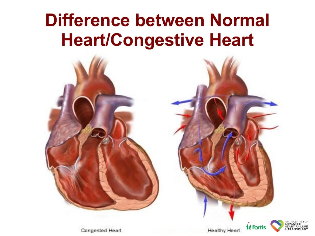 Can you treat congestive heart failure