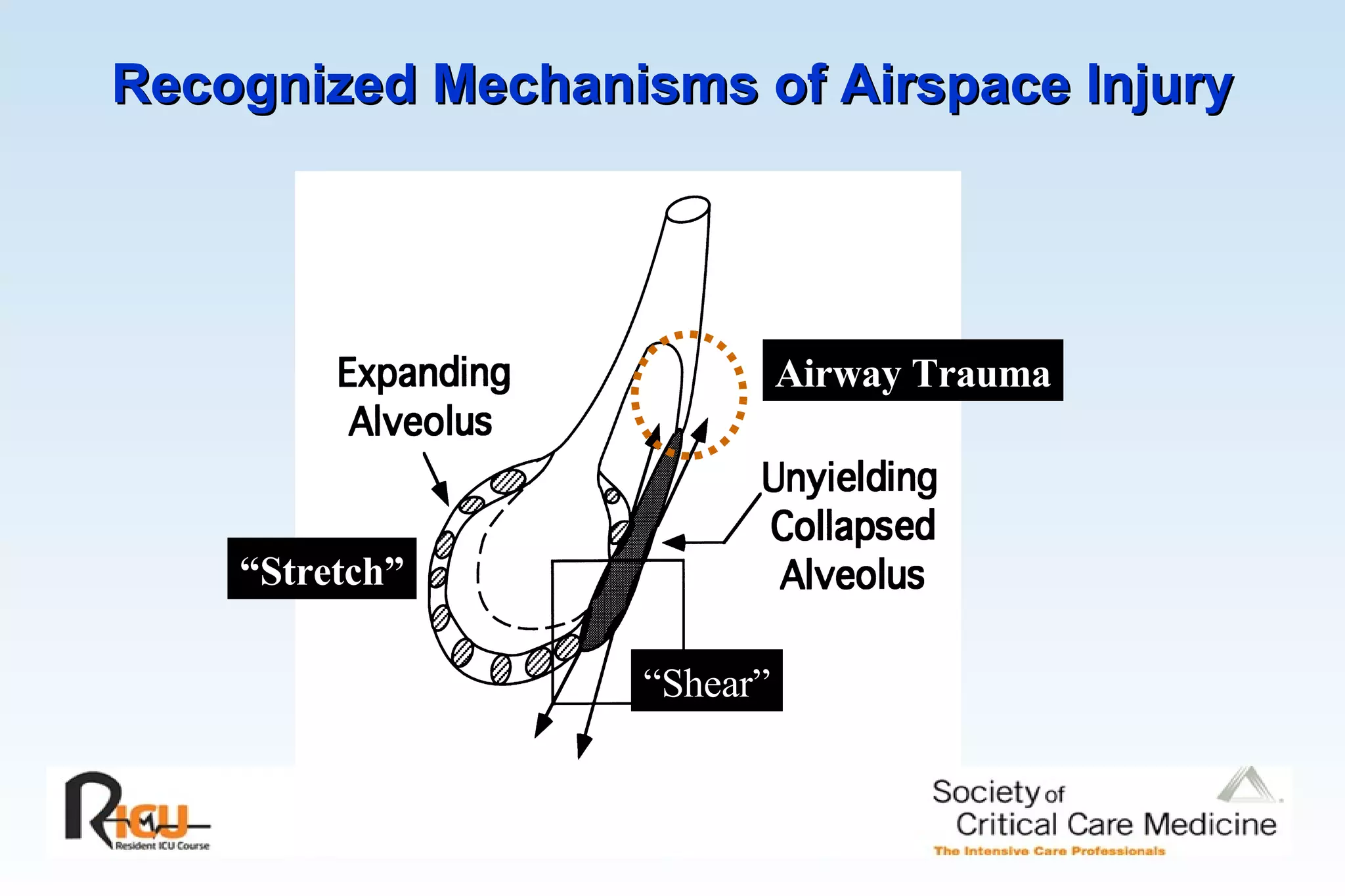 Recognized Mechanisms of Airspace Injury   “ Stretch” “ Shear” Airway Trauma 