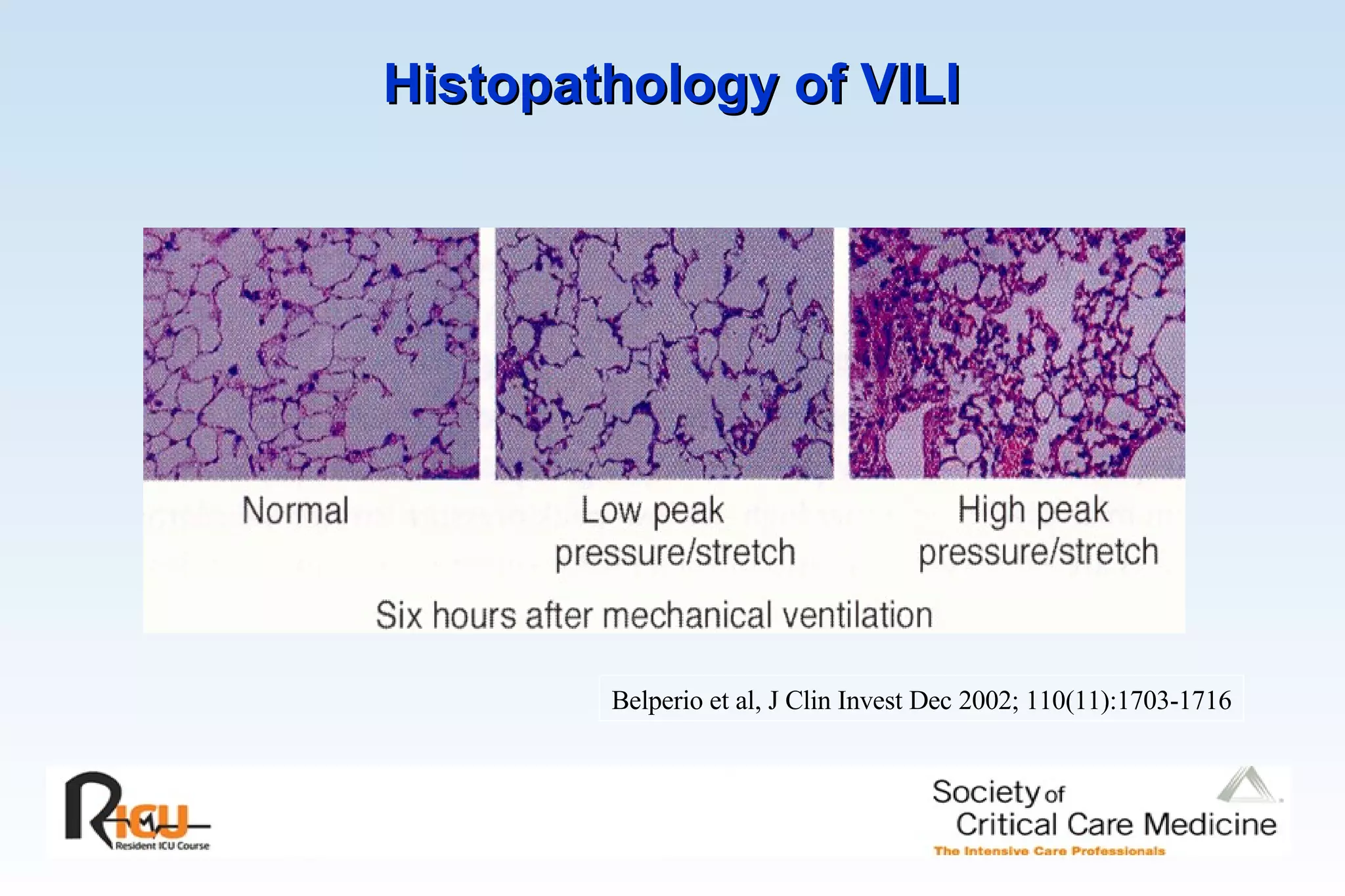 Histopathology of VILI   Belperio et al, J Clin Invest Dec 2002; 110(11):1703-1716 