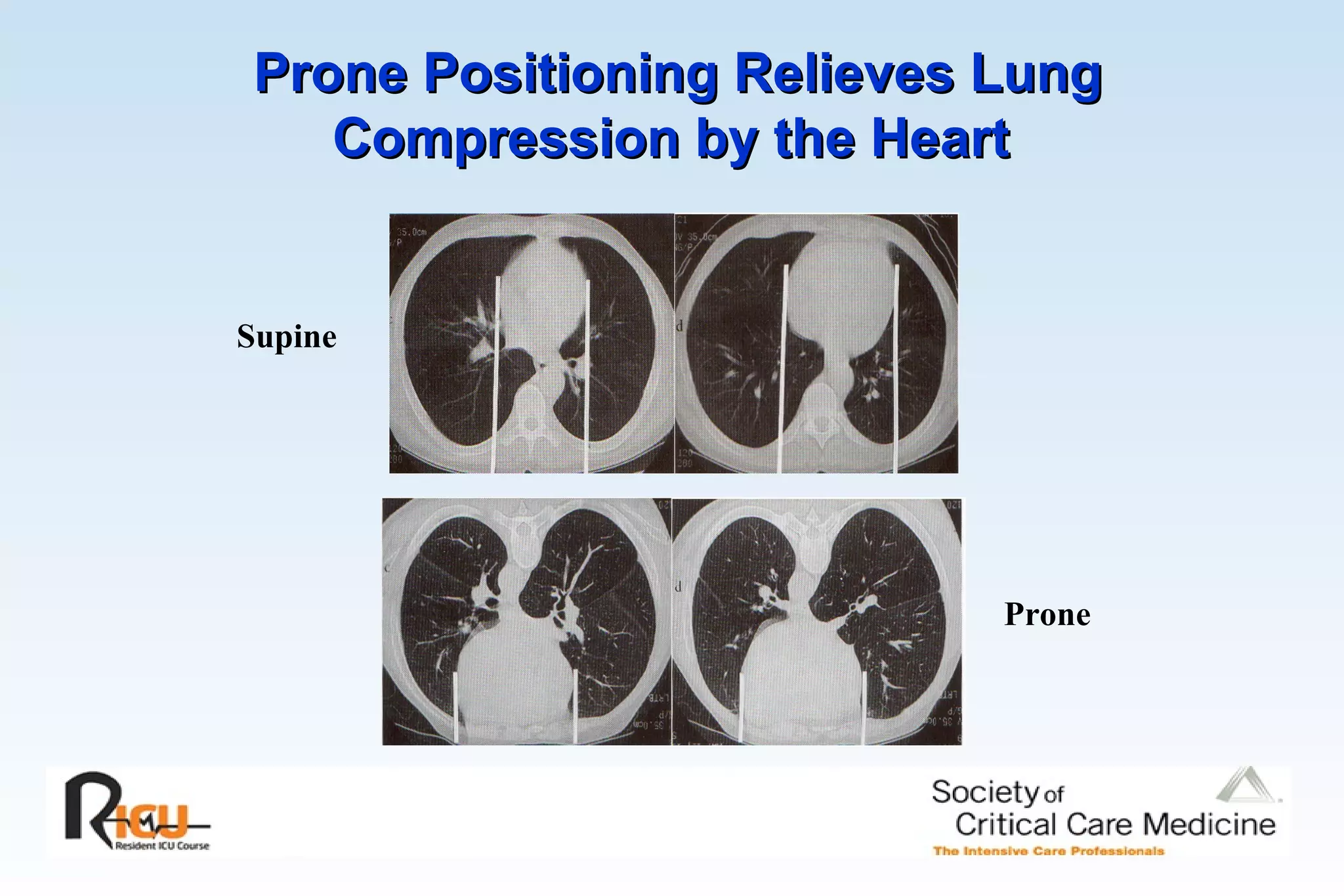 Prone Positioning Relieves Lung Compression by the Heart   Supine Prone 
