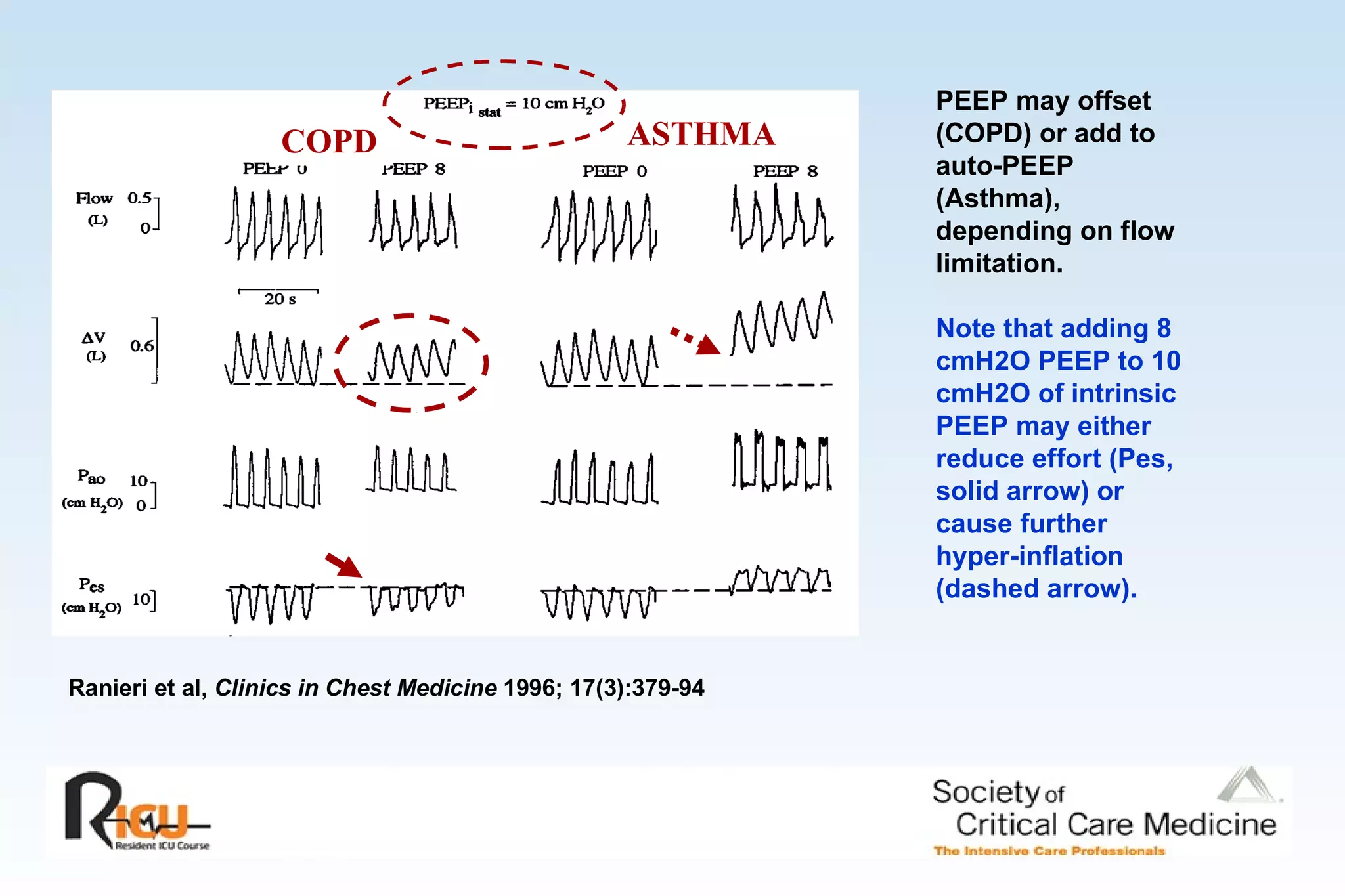 PEEP may offset  (COPD) or add to auto-PEEP (Asthma), depending on flow limitation. Note that adding 8 cmH2O PEEP to 10 cmH2O of intrinsic PEEP may either reduce effort (Pes, solid arrow) or cause further hyper-inflation (dashed arrow). Ranieri et al,  Clinics in Chest Medicine  1996; 17(3):379-94 ASTHMA COPD 