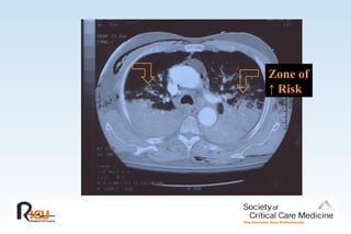 Advanced Mechanical Ventilation | PPT
