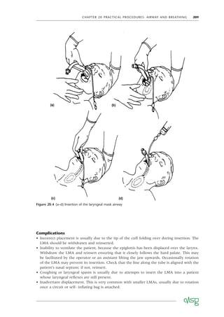CHAPTER 20 PRACTICAL PROCEDURES: AIRWAY AND BREATHING 209
Figure 20.4 (a–d) Insertion of the laryngeal mask airway
Complications
• Incorrect placement is usually due to the tip of the cuff folding over during insertion. The
LMA should be withdrawn and reinserted.
• Inability to ventilate the patient, because the epiglottis has been displaced over the larynx.
Withdraw the LMA and reinsert ensuring that it closely follows the hard palate. This may
be facilitated by the operator or an assistant lifting the jaw upwards. Occasionally rotation
of the LMA may prevent its insertion. Check that the line along the tube is aligned with the
patient’s nasal septum; if not, reinsert.
• Coughing or laryngeal spasm is usually due to attempts to insert the LMA into a patient
whose laryngeal reﬂexes are still present.
• Inadvertant displacement. This is very common with smaller LMAs, usually due to rotation
once a circuit or self- inﬂating bag is attached.
 