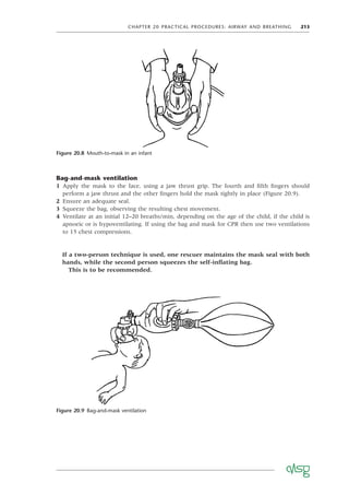 CHAPTER 20 PRACTICAL PROCEDURES: AIRWAY AND BREATHING 213
Bag-and-mask ventilation
1 Apply the mask to the face, using a jaw thrust grip. The fourth and ﬁfth ﬁngers should
perform a jaw thrust and the other ﬁngers hold the mask tightly in place (Figure 20.9).
2 Ensure an adequate seal.
3 Squeeze the bag, observing the resulting chest movement.
4 Ventilate at an initial 12–20 breaths/min, depending on the age of the child, if the child is
apnoeic or is hypoventilating. If using the bag and mask for CPR then use two ventilations
to 15 chest compressions.
If a two-person technique is used, one rescuer maintains the mask seal with both
hands, while the second person squeezes the self-inﬂating bag.
This is to be recommended.
Figure 20.8 Mouth-to-mask in an infant
Figure 20.9 Bag-and-mask ventilation
 