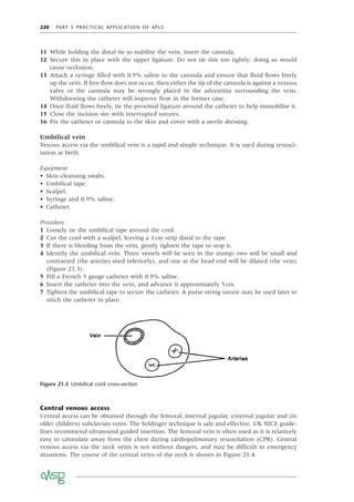 220 PART 5 PRACTICAL APPLICATION OF APLS
11 While holding the distal tie to stabilise the vein, insert the cannula.
12 Secure this in place with the upper ligature. Do not tie this too tightly; doing so would
cause occlusion.
13 Attach a syringe ﬁlled with 0.9% saline to the cannula and ensure that ﬂuid ﬂows freely
up the vein. If free ﬂow does not occur, then either the tip of the cannula is against a venous
valve or the cannula may be wrongly placed in the adventitia surrounding the vein.
Withdrawing the catheter will improve ﬂow in the former case.
14 Once ﬂuid ﬂows freely, tie the proximal ligature around the catheter to help immobilise it.
15 Close the incision site with interrupted sutures.
16 Fix the catheter or cannula to the skin and cover with a sterile dressing.
Umbilical vein
Venous access via the umbilical vein is a rapid and simple technique. It is used during resusci-
tation at birth.
Equipment
• Skin-cleansing swabs.
• Umbilical tape.
• Scalpel.
• Syringe and 0.9% saline.
• Catheter.
Procedure
1 Loosely tie the umbilical tape around the cord.
2 Cut the cord with a scalpel, leaving a 1cm strip distal to the tape.
3 If there is bleeding from the vein, gently tighten the tape to stop it.
4 Identify the umbilical vein. Three vessels will be seen in the stump: two will be small and
contracted (the arteries sited inferiorly), and one at the head end will be dilated (the vein)
(Figure 21.3).
5 Fill a French 5 gauge catheter with 0.9% saline.
6 Insert the catheter into the vein, and advance it approximately 5cm.
7 Tighten the umbilical tape to secure the catheter. A purse-string suture may be used later to
stitch the catheter in place.
Figure 21.3 Umbilical cord cross-section
Central venous access
Central access can be obtained through the femoral, internal jugular, external jugular and (in
older children) subclavian veins. The Seldinger technique is safe and effective. UK NICE guide-
lines recommend ultrasound guided insertion. The femoral vein is often used as it is relatively
easy to cannulate away from the chest during cardiopulmonary resuscitation (CPR). Central
venous access via the neck veins is not without dangers, and may be difﬁcult in emergency
situations. The course of the central veins of the neck is shown in Figure 21.4.
 