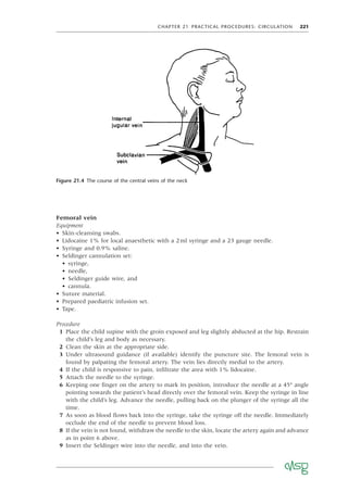 CHAPTER 21 PRACTICAL PROCEDURES: CIRCULATION 221
Femoral vein
Equipment
• Skin-cleansing swabs.
• Lidocaine 1% for local anaesthetic with a 2ml syringe and a 23 gauge needle.
• Syringe and 0.9% saline.
• Seldinger cannulation set:
• syringe,
• needle,
• Seldinger guide wire, and
• cannula.
• Suture material.
• Prepared paediatric infusion set.
• Tape.
Procedure
1 Place the child supine with the groin exposed and leg slightly abducted at the hip. Restrain
the child’s leg and body as necessary.
2 Clean the skin at the appropriate side.
3 Under ultrasound guidance (if available) identify the puncture site. The femoral vein is
found by palpating the femoral artery. The vein lies directly medial to the artery.
4 If the child is responsive to pain, inﬁltrate the area with 1% lidocaine.
5 Attach the needle to the syringe.
6 Keeping one ﬁnger on the artery to mark its position, introduce the needle at a 45° angle
pointing towards the patient’s head directly over the femoral vein. Keep the syringe in line
with the child’s leg. Advance the needle, pulling back on the plunger of the syringe all the
time.
7 As soon as blood ﬂows back into the syringe, take the syringe off the needle. Immediately
occlude the end of the needle to prevent blood loss.
8 If the vein is not found, withdraw the needle to the skin, locate the artery again and advance
as in point 6 above.
9 Insert the Seldinger wire into the needle, and into the vein.
Figure 21.4 The course of the central veins of the neck
 