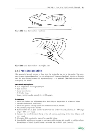 CHAPTER 22 PRACTICAL PROCEDURES: TRAUMA 231
22.3 PERICARDIOCENTESIS
The removal of a small amount of ﬂuid from the pericardial sac can be life-saving. The proce-
dure is not without risks and the electrocardiogram (ECG) should be closely monitored through-
out. An acute injury pattern (ST segment changes or a widened QRS) indicates ventricular
damage by the needle.
Minimum equipment
• Skin preparation and surgical drapes.
• ECG monitor.
• (Local anaesthetic.)
• A 20ml syringe.
• Large over-the-needle cannula (16 or 18 gauge).
Procedure
1 Swab the xiphoid and subxiphoid areas with surgical preparation or an alcohol swab.
2 Use local anaesthetic if necessary.
3 Assess the patient for any signiﬁcant mediastinal shift if possible.
4 Attach the syringe to the needle.
5 Puncture the skin 1–2cm inferior to the left side of the xiphoid junction at a 45° angle
(Figure 22.4, over page).
6 Advance the needle towards the tip of the left scapula, aspirating all the time (Figure 22.5,
over page).
7 Watch the ECG monitor for signs of myocardial injury.
8 Once ﬂuid is withdrawn, aspirate as much as possible (unless it is possible to withdraw limit-
less amounts of blood, in which case a ventricle has probably been entered).
Figure 22.2 Chest drain insertion – landmarks
Figure 22.3 Chest drain insertion – clearing the path
 
