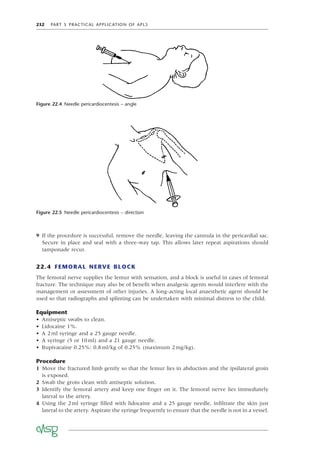 232 PART 5 PRACTICAL APPLICATION OF APLS
9 If the procedure is successful, remove the needle, leaving the cannula in the pericardial sac.
Secure in place and seal with a three-way tap. This allows later repeat aspirations should
tamponade recur.
22.4 FEMORAL NERVE BLOCK
The femoral nerve supplies the femur with sensation, and a block is useful in cases of femoral
fracture. The technique may also be of beneﬁt when analgesic agents would interfere with the
management or assessment of other injuries. A long-acting local anaesthetic agent should be
used so that radiographs and splinting can be undertaken with minimal distress to the child.
Equipment
• Antiseptic swabs to clean.
• Lidocaine 1%.
• A 2ml syringe and a 25 gauge needle.
• A syringe (5 or 10ml) and a 21 gauge needle.
• Bupivacaine 0.25%: 0.8ml/kg of 0.25% (maximum 2mg/kg).
Procedure
1 Move the fractured limb gently so that the femur lies in abduction and the ipsilateral groin
is exposed.
2 Swab the groin clean with antiseptic solution.
3 Identify the femoral artery and keep one ﬁnger on it. The femoral nerve lies immediately
lateral to the artery.
4 Using the 2ml syringe ﬁlled with lidocaine and a 25 gauge needle, inﬁltrate the skin just
lateral to the artery. Aspirate the syringe frequently to ensure that the needle is not in a vessel.
Figure 22.4 Needle pericardiocentesis – angle
Figure 22.5 Needle pericardiocentesis – direction
 