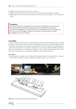 236 PART 5 PRACTICAL APPLICATION OF APLS
Figure 22.7 Log-rolling a child (four-person technique)
An injured child may be uncooperative for many reasons including fear, pain and hypoxia.
Manual immobilisation should be maintained and the contributing factors addressed.
Overzealous immobilisation of the head and neck may paradoxically increase the leverage on
the neck as the child struggles. Children with traumatic torticollis should be manually
immobilised in their current position.
Exceptions
3 Apply the forehead strap and attach it securely.
4 Apply the lower strap across the chin piece of the hard collar and attach it securely.
5 Apply tape across the chin piece of the hard collar and securely attach it to the long spinal
board.
Log-rolling
In order to minimise the chances of exacerbating unrecognised spinal cord injury, non-essential
movements of the spine must be avoided until adequate examination and investigations have
excluded it. If manoeuvres that might cause spinal movement are essential (e.g. during exami-
nation of the back in the course of the secondary survey), then log-rolling should be performed.
The aim of log-rolling is to maintain the alignment of the spine during turning of the child.
The basic requirements are an adequate number of carers and good control.
Procedure
1 Gather together enough staff to roll the child. In larger children four people will be required;
three will be required in smaller children and infants (Figures 22.7 and 22.8).
 