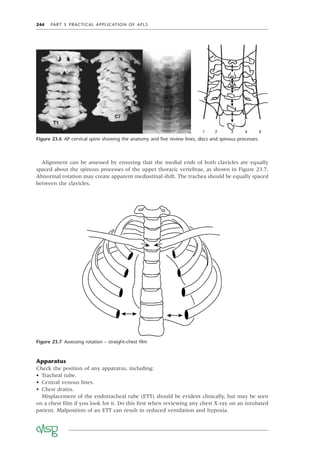 244 PART 5 PRACTICAL APPLICATION OF APLS
Figure 23.7 Assessing rotation – straight-chest ﬁlm
Figure 23.6 AP cervical spine showing the anatomy and ﬁve review lines, discs and spinous processes.
Apparatus
Check the position of any apparatus, including:
• Tracheal tube.
• Central venous lines.
• Chest drains.
Misplacement of the endotracheal tube (ETT) should be evident clinically, but may be seen
on a chest ﬁlm if you look for it. Do this ﬁrst when reviewing any chest X-ray on an intubated
patient. Malposition of an ETT can result in reduced ventilation and hypoxia.
Alignment can be assessed by ensuring that the medial ends of both clavicles are equally
spaced about the spinous processes of the upper thoracic vertebrae, as shown in Figure 23.7.
Abnormal rotation may create apparent mediastinal shift. The trachea should be equally spaced
between the clavicles.
 