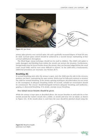 CHAPTER 4 BASIC LIFE SUPPORT 23
airway takes priority over cervical spine risk and a gradually increased degree of head tilt may
be tried. Cervical spine control should be achieved by a second rescuer maintaining in-line
cervical stabilisation throughout.
The blind ﬁnger sweep technique should not be used in children. The child’s soft palate is
easily damaged, and bleeding from within the mouth can worsen the situation. Furthermore,
foreign bodies may be forced further down the airway; they can become lodged below the vocal
cords (vocal folds) and be even more difﬁcult to remove. In the child with a tracheostomy,
additional procedures are necessary (see Section 20.7).
Breathing (B)
If normal breathing starts after the airway is open, turn the child onto his side in the recovery
position (see later), maintaining the open airway. Send or go for help and continue to monitor
the child for normal breathing. If the airway opening techniques described above do not result
in the resumption of adequate breathing within 10 seconds, exhaled air resuscitation should
be commenced. The rescuer should distinguish between adequate breathing and ineffective,
gasping or obstructed breathing. If in doubt, attempt rescue breathing.
Five initial rescue breaths should be given.
While the airway is kept open as described above, the rescuer breathes in and seals his or her
mouth around the victim’s mouth (for a child), or mouth and nose (for an infant, as shown
in Figure 4.6). If the mouth alone is used then the nose should be pinched closed using the
Figure 4.5 Jaw thrust
Figure 4.6 Mouth to mouth-
and-nose in an infant
 