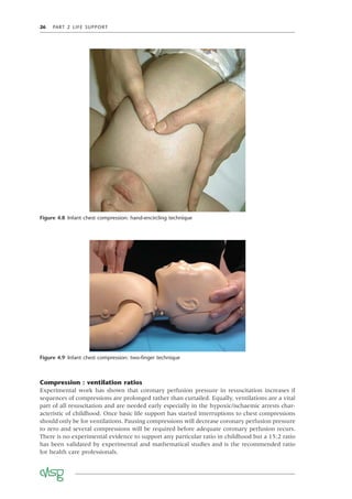 26 PART 2 LIFE SUPPORT
Figure 4.8 Infant chest compression: hand-encircling technique
Figure 4.9 Infant chest compression: two-ﬁnger technique
Compression : ventilation ratios
Experimental work has shown that coronary perfusion pressure in resuscitation increases if
sequences of compressions are prolonged rather than curtailed. Equally, ventilations are a vital
part of all resuscitation and are needed early especially in the hypoxic/ischaemic arrests char-
acteristic of childhood. Once basic life support has started interruptions to chest compressions
should only be for ventilations. Pausing compressions will decrease coronary perfusion pressure
to zero and several compressions will be required before adequate coronary perfusion recurs.
There is no experimental evidence to support any particular ratio in childhood but a 15:2 ratio
has been validated by experimental and mathematical studies and is the recommended ratio
for health care professionals.
 