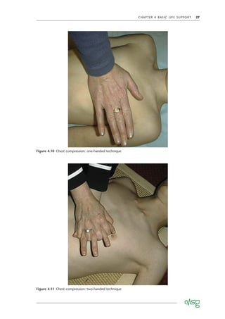 CHAPTER 4 BASIC LIFE SUPPORT 27
Figure 4.10 Chest compression: one-handed technique
Figure 4.11 Chest compression: two-handed technique
 