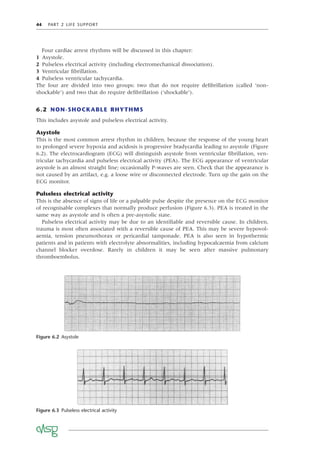 44 PART 2 LIFE SUPPORT
Four cardiac arrest rhythms will be discussed in this chapter:
1 Asystole.
2 Pulseless electrical activity (including electromechanical dissociation).
3 Ventricular ﬁbrillation.
4 Pulseless ventricular tachycardia.
The four are divided into two groups: two that do not require deﬁbrillation (called ‘non-
shockable’) and two that do require deﬁbrillation (‘shockable’).
6.2 NON-SHOCKABLE RHYTHMS
This includes asystole and pulseless electrical activity.
Asystole
This is the most common arrest rhythm in children, because the response of the young heart
to prolonged severe hypoxia and acidosis is progressive bradycardia leading to asystole (Figure
6.2). The electrocardiogram (ECG) will distinguish asystole from ventricular ﬁbrillation, ven-
tricular tachycardia and pulseless electrical activity (PEA). The ECG appearance of ventricular
asystole is an almost straight line; occasionally P-waves are seen. Check that the appearance is
not caused by an artifact, e.g. a loose wire or disconnected electrode. Turn up the gain on the
ECG monitor.
Pulseless electrical activity
This is the absence of signs of life or a palpable pulse despite the presence on the ECG monitor
of recognisable complexes that normally produce perfusion (Figure 6.3). PEA is treated in the
same way as asystole and is often a pre-asystolic state.
Pulseless electrical activity may be due to an identiﬁable and reversible cause. In children,
trauma is most often associated with a reversible cause of PEA. This may be severe hypovol-
aemia, tension pneumothorax or pericardial tamponade. PEA is also seen in hypothermic
patients and in patients with electrolyte abnormalities, including hypocalcaemia from calcium
channel blocker overdose. Rarely in children it may be seen after massive pulmonary
thromboembolus.
Figure 6.2 Asystole
Figure 6.3 Pulseless electrical activity
 