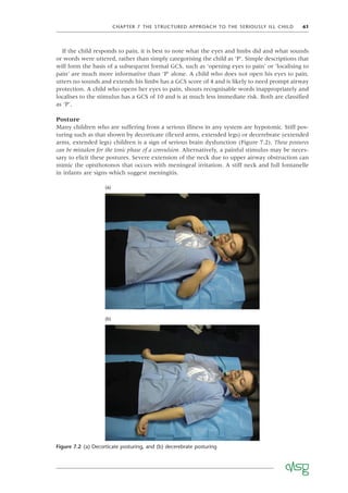 CHAPTER 7 THE STRUCTURED APPROACH TO THE SERIOUSLY ILL CHILD 61
If the child responds to pain, it is best to note what the eyes and limbs did and what sounds
or words were uttered, rather than simply categorising the child as ‘P’. Simple descriptions that
will form the basis of a subsequent formal GCS, such as ‘opening eyes to pain’ or ‘localising to
pain’ are much more informative than ‘P’ alone. A child who does not open his eyes to pain,
utters no sounds and extends his limbs has a GCS score of 4 and is likely to need prompt airway
protection. A child who opens her eyes to pain, shouts recognisable words inappropriately and
localises to the stimulus has a GCS of 10 and is at much less immediate risk. Both are classiﬁed
as ‘P’.
Posture
Many children who are suffering from a serious illness in any system are hypotonic. Stiff pos-
turing such as that shown by decorticate (ﬂexed arms, extended legs) or decerebrate (extended
arms, extended legs) children is a sign of serious brain dysfunction (Figure 7.2). These postures
can be mistaken for the tonic phase of a convulsion. Alternatively, a painful stimulus may be neces-
sary to elicit these postures. Severe extension of the neck due to upper airway obstruction can
mimic the opisthotonos that occurs with meningeal irritation. A stiff neck and full fontanelle
in infants are signs which suggest meningitis.
Figure 7.2 (a) Decorticate posturing, and (b) decerebrate posturing
(a)
(b)
 