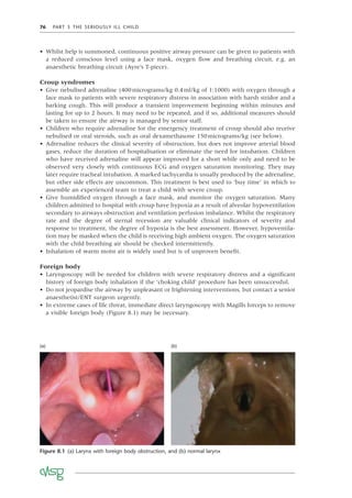 76 PART 3 THE SERIOUSLY ILL CHILD
• Whilst help is summoned, continuous positive airway pressure can be given to patients with
a reduced conscious level using a face mask, oxygen ﬂow and breathing circuit, e.g. an
anaesthetic breathing circuit (Ayre’s T-piece).
Croup syndromes
• Give nebulised adrenaline (400micrograms/kg 0.4ml/kg of 1:1000) with oxygen through a
face mask to patients with severe respiratory distress in association with harsh stridor and a
barking cough. This will produce a transient improvement beginning within minutes and
lasting for up to 2 hours. It may need to be repeated, and if so, additional measures should
be taken to ensure the airway is managed by senior staff.
• Children who require adrenaline for the emergency treatment of croup should also receive
nebulised or oral steroids, such as oral dexamethasone 150micrograms/kg (see below).
• Adrenaline reduces the clinical severity of obstruction, but does not improve arterial blood
gases, reduce the duration of hospitalisation or eliminate the need for intubation. Children
who have received adrenaline will appear improved for a short while only and need to be
observed very closely with continuous ECG and oxygen saturation monitoring. They may
later require tracheal intubation. A marked tachycardia is usually produced by the adrenaline,
but other side effects are uncommon. This treatment is best used to ‘buy time’ in which to
assemble an experienced team to treat a child with severe croup.
• Give humidiﬁed oxygen through a face mask, and monitor the oxygen saturation. Many
children admitted to hospital with croup have hypoxia as a result of alveolar hypoventilation
secondary to airways obstruction and ventilation perfusion imbalance. Whilst the respiratory
rate and the degree of sternal recession are valuable clinical indicators of severity and
response to treatment, the degree of hypoxia is the best assessment. However, hypoventila-
tion may be masked when the child is receiving high ambient oxygen. The oxygen saturation
with the child breathing air should be checked intermittently.
• Inhalation of warm moist air is widely used but is of unproven beneﬁt.
Foreign body
• Laryngoscopy will be needed for children with severe respiratory distress and a signiﬁcant
history of foreign body inhalation if the ‘choking child’ procedure has been unsuccessful.
• Do not jeopardise the airway by unpleasant or frightening interventions, but contact a senior
anaesthetist/ENT surgeon urgently.
• In extreme cases of life threat, immediate direct laryngoscopy with Magills forceps to remove
a visible foreign body (Figure 8.1) may be necessary.
Figure 8.1 (a) Larynx with foreign body obstruction, and (b) normal larynx
(a) (b)
 
