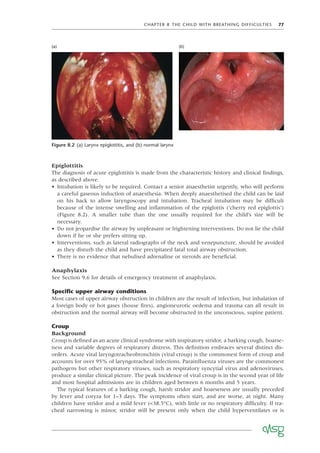 CHAPTER 8 THE CHILD WITH BREATHING DIFFICULTIES 77
Epiglottitis
The diagnosis of acute epiglottitis is made from the characteristic history and clinical ﬁndings,
as described above.
• Intubation is likely to be required. Contact a senior anaesthetist urgently, who will perform
a careful gaseous induction of anaesthesia. When deeply anaesthetised the child can be laid
on his back to allow laryngoscopy and intubation. Tracheal intubation may be difﬁcult
because of the intense swelling and inﬂammation of the epiglottis (‘cherry red epiglottis’)
(Figure 8.2). A smaller tube than the one usually required for the child’s size will be
necessary.
• Do not jeopardise the airway by unpleasant or frightening interventions. Do not lie the child
down if he or she prefers sitting up.
• Interventions, such as lateral radiographs of the neck and venepuncture, should be avoided
as they disturb the child and have precipitated fatal total airway obstruction.
• There is no evidence that nebulised adrenaline or steroids are beneﬁcial.
Anaphylaxis
See Section 9.6 for details of emergency treatment of anaphylaxis.
Speciﬁc upper airway conditions
Most cases of upper airway obstruction in children are the result of infection, but inhalation of
a foreign body or hot gases (house ﬁres), angioneurotic oedema and trauma can all result in
obstruction and the normal airway will become obstructed in the unconscious, supine patient.
Croup
Background
Croup is deﬁned as an acute clinical syndrome with inspiratory stridor, a barking cough, hoarse-
ness and variable degrees of respiratory distress. This deﬁnition embraces several distinct dis-
orders. Acute viral laryngotracheobronchitis (viral croup) is the commonest form of croup and
accounts for over 95% of laryngotracheal infections. Parainﬂuenza viruses are the commonest
pathogens but other respiratory viruses, such as respiratory syncytial virus and adenoviruses,
produce a similar clinical picture. The peak incidence of viral croup is in the second year of life
and most hospital admissions are in children aged between 6 months and 5 years.
The typical features of a barking cough, harsh stridor and hoarseness are usually preceded
by fever and coryza for 1–3 days. The symptoms often start, and are worse, at night. Many
children have stridor and a mild fever (<38.5°C), with little or no respiratory difﬁculty. If tra-
cheal narrowing is minor, stridor will be present only when the child hyperventilates or is
Figure 8.2 (a) Larynx epiglottitis, and (b) normal larynx
(a) (b)
 