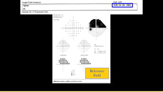 Deperimeterization Example Advanced perimetry-interpretation | PDF