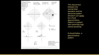 Deperimeterization Example Advanced perimetry-interpretation | PDF