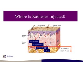 Where is Radiesse Injected? Mid-Dermis Deep Dermis Dermis/SQ Jx. Sub-Q Radiesse Safe Area 