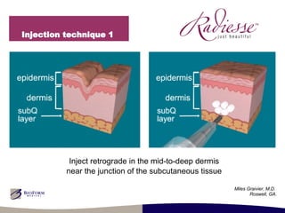 Injection technique 1  Inject retrograde in the mid-to-deep dermis near the junction of the subcutaneous tissue Miles Graivier, M.D.  Roswell, GA. 