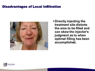 Disadvantages of Local Infiltration Directly injecting the treatment site distorts the area to be filled and can skew the injector’s judgment as to when optimal filling has been accomplished. 