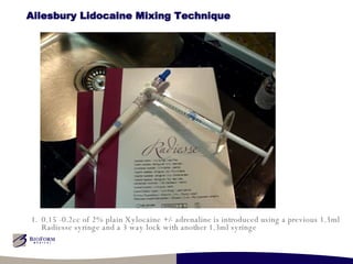 Ailesbury Lidocaine Mixing Technique 0.15 -0.2cc of 2% plain Xylocaine +/- adrenaline is introduced using a previous 1.3ml Radiesse syringe and a 3 way lock with another 1.3ml syringe 