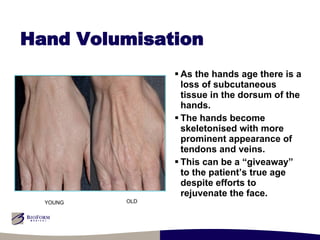 Hand Volumisation As the hands age there is a loss of subcutaneous tissue in the dorsum of the hands. The hands become skeletonised with more prominent appearance of tendons and veins. This can be a “giveaway” to the patient’s true age despite efforts to rejuvenate the face. YOUNG OLD 