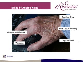 Signs of Ageing Hand  Soft Tissue Atrophy Pigmentation  Venous prominence Tendon Show  Wrinkles 