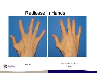 Radiesse in Hands Before Immediately After 1.3 cc 