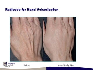Radiesse for Hand Volumisation Before Immediately After 1.3 cc Mike Jasin, MD  Tampa, FL 