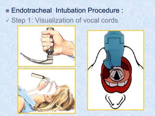  Endotracheal Intubation Procedure :
 Step 1: Visualization of vocal cords
 