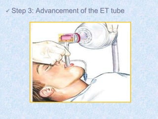  Step 3: Advancement of the ET tube
 