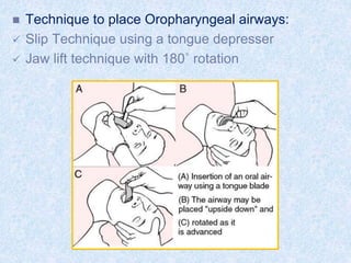  Technique to place Oropharyngeal airways:
 Slip Technique using a tongue depresser
 Jaw lift technique with 180˚ rotation
 