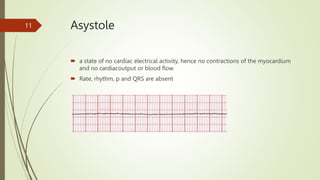 Asystole
 a state of no cardiac electrical activity, hence no contractions of the myocardium
and no cardiacoutput or blood flow.
 Rate, rhythm, p and QRS are absent
11
 