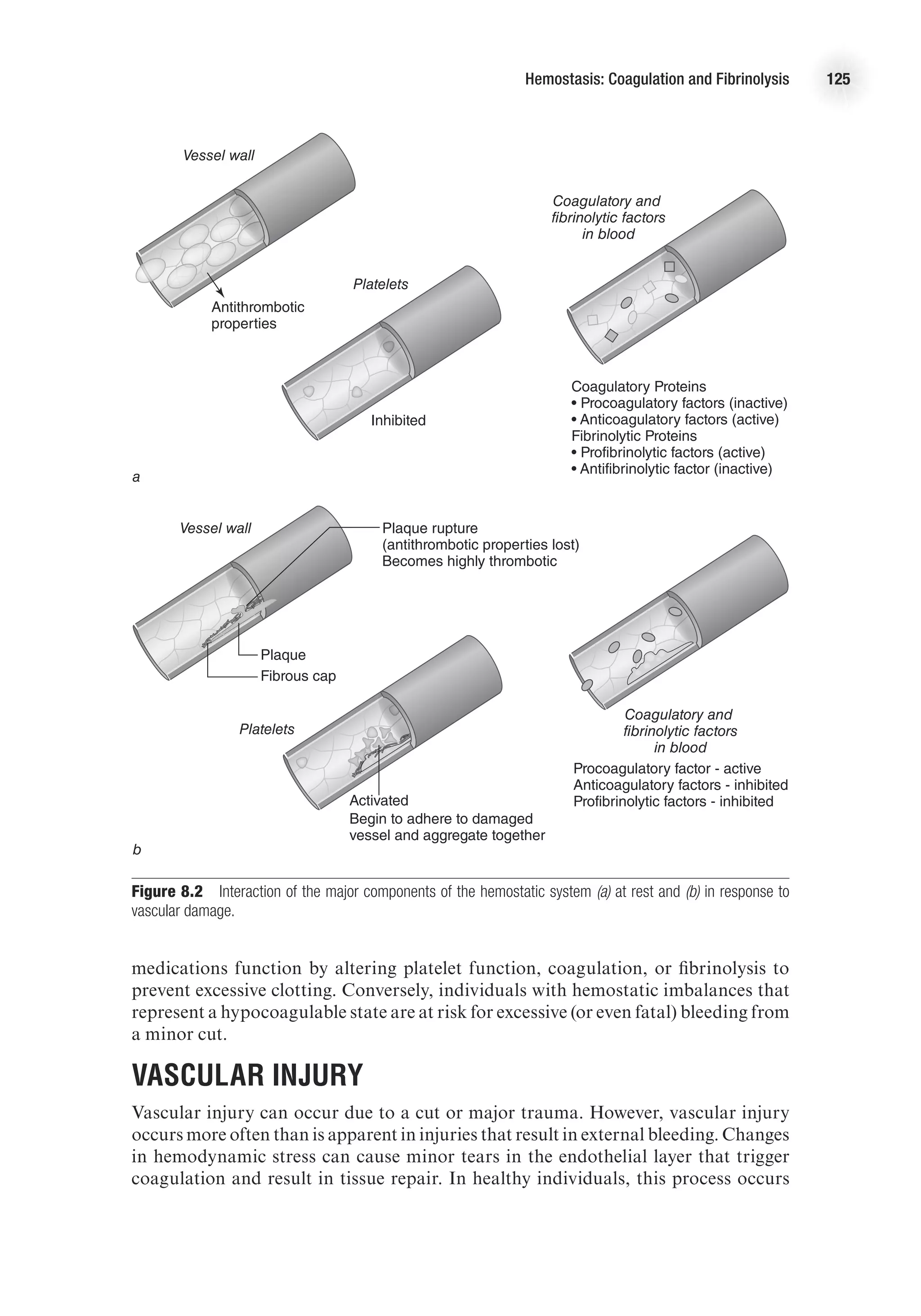 Hemostasis: Coagulation and Fibrinolysis 125
medications function by altering platelet function, coagulation, or fibrinolysis to
prevent excessive clotting. Conversely, individuals with hemostatic imbalances that
represent a hypocoagulable state are at risk for excessive (or even fatal) bleeding from
a minor cut.
Vascular Injury
Vascular injury can occur due to a cut or major trauma. However, vascular injury
occurs more often than is apparent in injuries that result in external bleeding. Changes
in hemodynamic stress can cause minor tears in the endothelial layer that trigger
coagulation and result in tissue repair. In healthy individuals, this process occurs
Antithrombotic
properties
a
Vessel wall
Platelets
Coagulatory and
fibrinolytic factors
in blood
Inhibited
Coagulatory Proteins
• Procoagulatory factors (inactive)
• Anticoagulatory factors (active)
Fibrinolytic Proteins
• Profibrinolytic factors (active)
• Antifibrinolytic factor (inactive)
E4414/Smith/Fig. 8.2a/384297/RR/R2
Plaque rupture
(antithrombotic properties lost)
Becomes highly thrombotic
b
Vessel wall
Platelets
Coagulatory and
fibrinolytic factors
in blood
Activated
Procoagulatory factor - active
Anticoagulatory factors - inhibited
Profibrinolytic factors - inhibited
Begin to adhere to damaged
vessel and aggregate together
Plaque
Fibrous cap
E4414/Smith/Fig. 8.2b/350011/RR/R2
Figure 8.2  Interaction of the major components of the hemostatic system (a) at rest and (b) in response to
vascular damage.
 