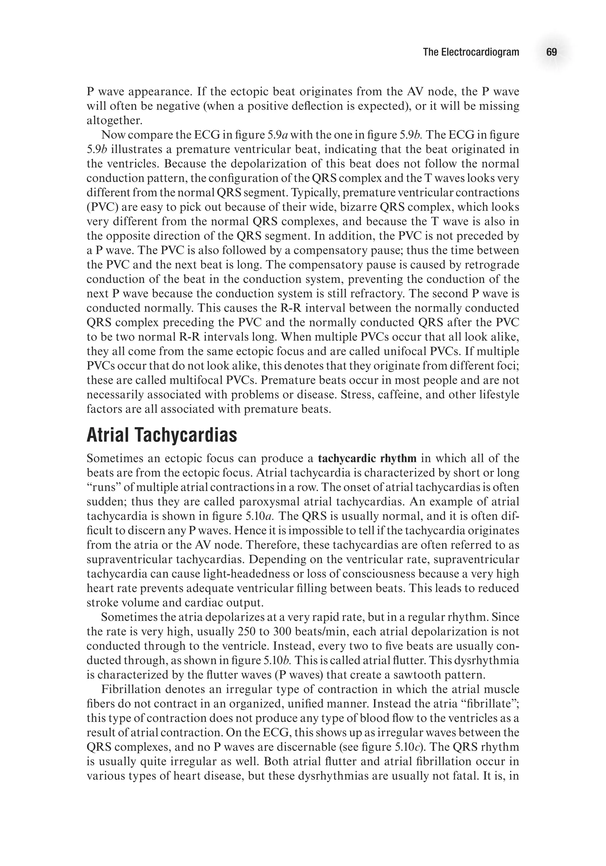 The Electrocardiogram 69
P wave appearance. If the ectopic beat originates from the AV node, the P wave
will often be negative (when a positive deflection is expected), or it will be missing
altogether.
Now compare the ECG in figure 5.9a with the one in figure 5.9b. The ECG in figure
5.9b illustrates a premature ventricular beat, indicating that the beat originated in
the ventricles. Because the depolarization of this beat does not follow the normal
conduction pattern, the configuration of the QRS complex and the T waves looks very
different from the normal QRS segment. Typically, premature ventricular contractions
(PVC) are easy to pick out because of their wide, bizarre QRS complex, which looks
very different from the normal QRS complexes, and because the T wave is also in
the opposite direction of the QRS segment. In addition, the PVC is not preceded by
a P wave. The PVC is also followed by a compensatory pause; thus the time between
the PVC and the next beat is long. The compensatory pause is caused by retrograde
conduction of the beat in the conduction system, preventing the conduction of the
next P wave because the conduction system is still refractory. The second P wave is
conducted normally. This causes the R-R interval between the normally conducted
QRS complex preceding the PVC and the normally conducted QRS after the PVC
to be two normal R-R intervals long. When multiple PVCs occur that all look alike,
they all come from the same ectopic focus and are called unifocal PVCs. If multiple
PVCs occur that do not look alike, this denotes that they originate from different foci;
these are called multifocal PVCs. Premature beats occur in most people and are not
necessarily associated with problems or disease. Stress, caffeine, and other lifestyle
factors are all associated with premature beats.
Atrial Tachycardias
Sometimes an ectopic focus can produce a tachycardic rhythm in which all of the
beats are from the ectopic focus. Atrial tachycardia is characterized by short or long
“runs” of multiple atrial contractions in a row. The onset of atrial tachycardias is often
sudden; thus they are called paroxysmal atrial tachycardias. An example of atrial
tachycardia is shown in figure 5.10a. The QRS is usually normal, and it is often dif-
ficult to discern any P waves. Hence it is impossible to tell if the tachycardia originates
from the atria or the AV node. Therefore, these tachycardias are often referred to as
supraventricular tachycardias. Depending on the ventricular rate, supraventricular
tachycardia can cause light-headedness or loss of consciousness because a very high
heart rate prevents adequate ventricular filling between beats. This leads to reduced
stroke volume and cardiac output.
Sometimes the atria depolarizes at a very rapid rate, but in a regular rhythm. Since
the rate is very high, usually 250 to 300 beats/min, each atrial depolarization is not
conducted through to the ventricle. Instead, every two to five beats are usually con-
ducted through, as shown in figure 5.10b. This is called atrial flutter. This dysrhythmia
is characterized by the flutter waves (P waves) that create a sawtooth pattern.
Fibrillation denotes an irregular type of contraction in which the atrial muscle
fibers do not contract in an organized, unified manner. Instead the atria “fibrillate”;
this type of contraction does not produce any type of blood flow to the ventricles as a
result of atrial contraction. On the ECG, this shows up as irregular waves between the
QRS complexes, and no P waves are discernable (see figure 5.10c). The QRS rhythm
is usually quite irregular as well. Both atrial flutter and atrial fibrillation occur in
various types of heart disease, but these dysrhythmias are usually not fatal. It is, in
 